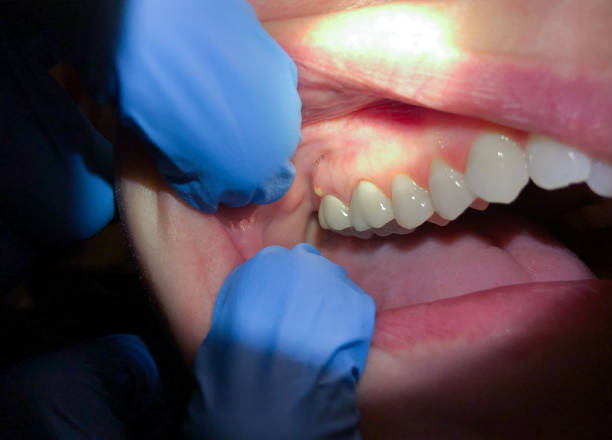 Best Urgent Tooth Repair  in Spanish Fort, AL