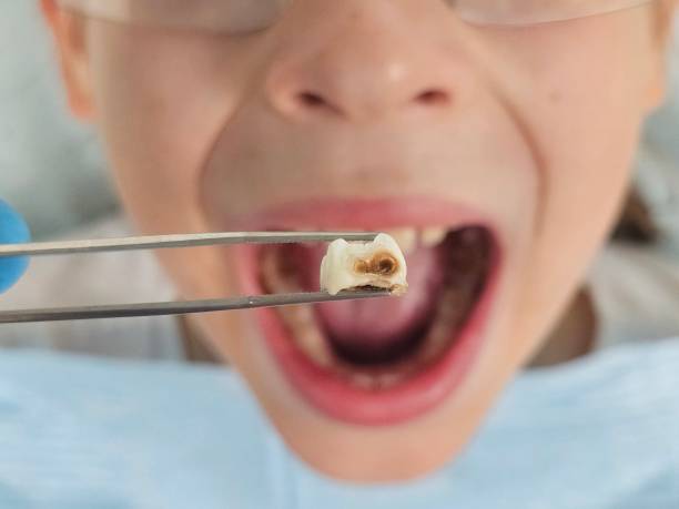 Best Emergency Tooth Extraction  in Spanish Fort, AL